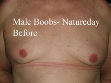 before-male-boobs