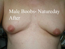 after-male-boobs
